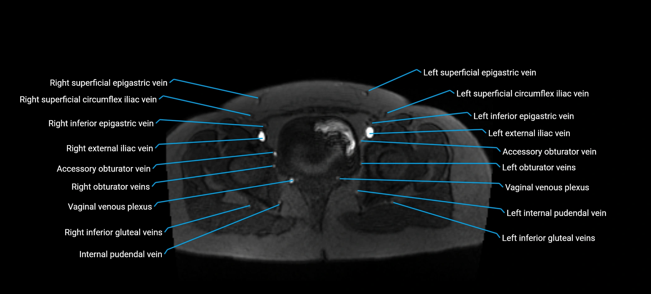 MRV abdomen pelvis & lower limb axial cross sectional anatomy labelled MRI image 179 (1).webp